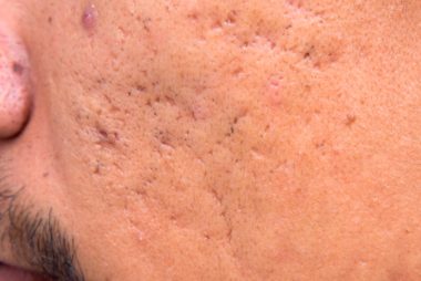 01-icepick-The-5-Types-of-Acne-Scars-and-How-to-Treat-Them-211513207-Only-background