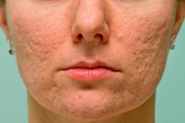02-boxcar-The-5-Types-of-Acne-Scars-and-How-to-Treat-Them-170660708-Budimir-Jevtic